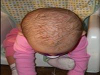 cradle cap on baby pictures