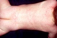 roseola rash on baby