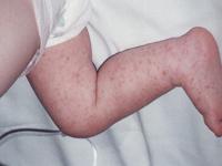 viral rash on baby
