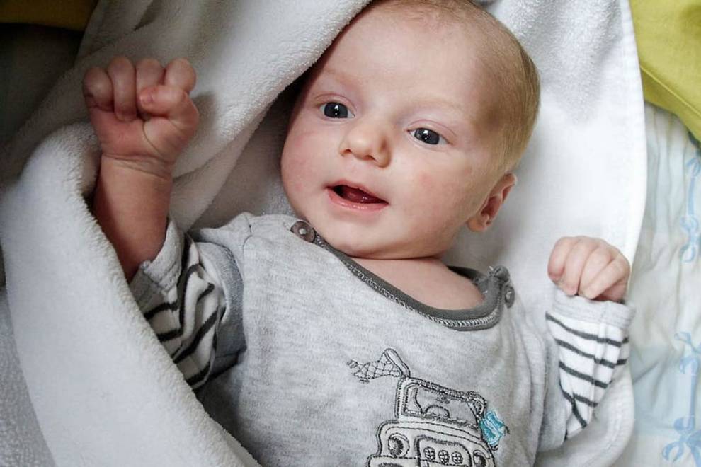 All About Baby Acne